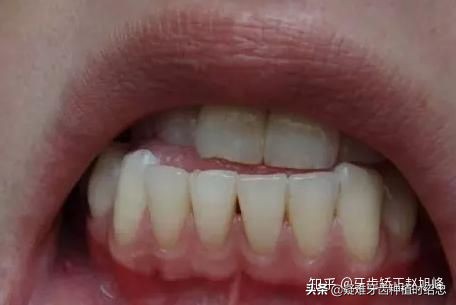 牙龈萎缩导致牙缝变大能治疗吗,牙龈萎缩牙缝变大可以做刮龈吗