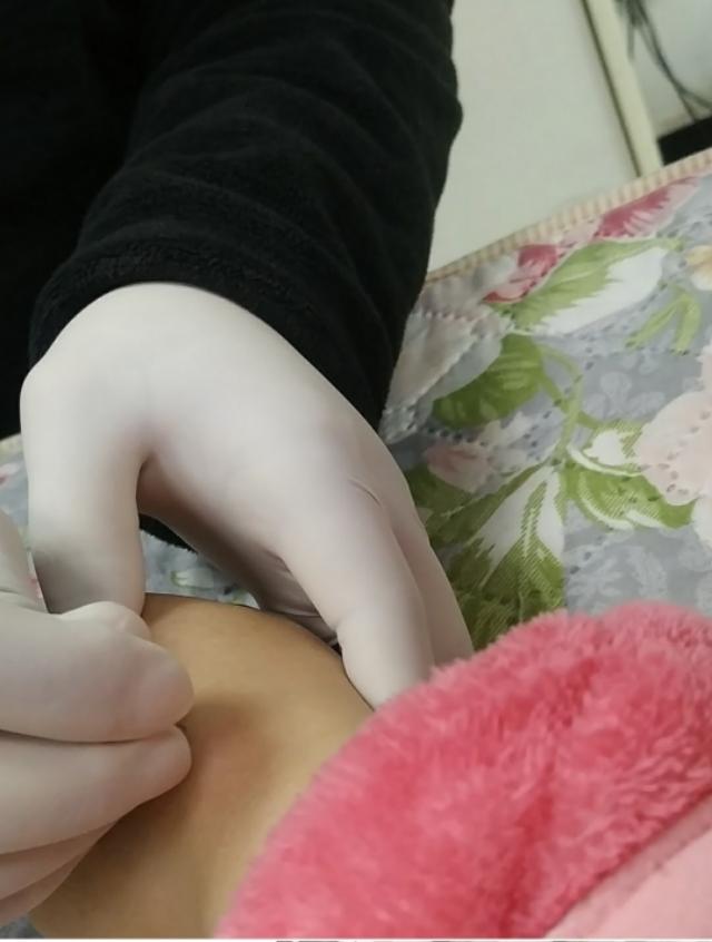 腱鞘囊肿中医神奇治疗方法,腱鞘囊肿针灸治疗