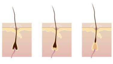 头发脱发毛囊堵塞怎么治疗,毛囊堵塞导致脱发