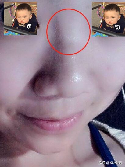 鼻梁可以捏真的假的,捏鼻梁神器变高真的吗