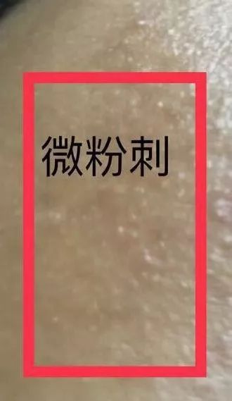 背部长痘挤出来有恶臭味,背部长痘是什么原因