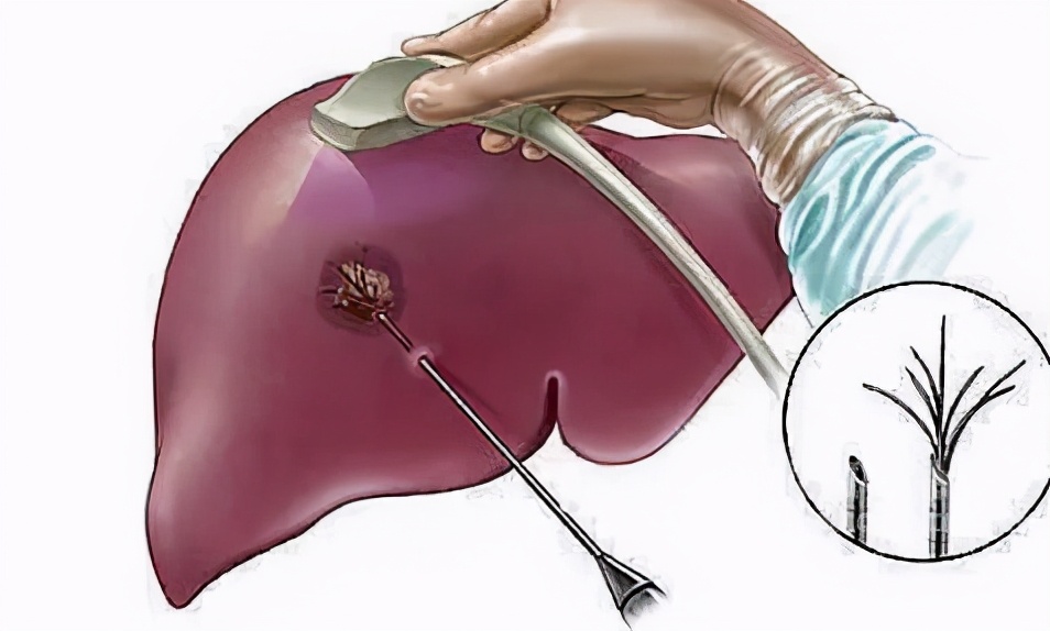 微创手术能根治肝癌,肝癌微创消融手术效果好吗知乎