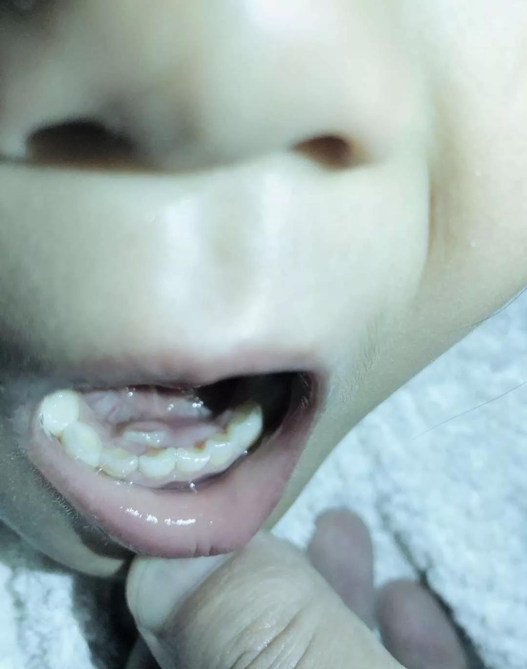 如何预防宝宝的双排牙,换牙出现双排牙不齐怎么办