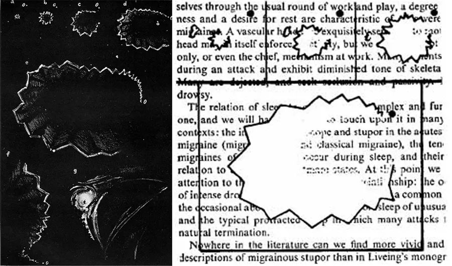 偏头痛的症状和表现有哪些,各种偏头痛的症状和治疗方法