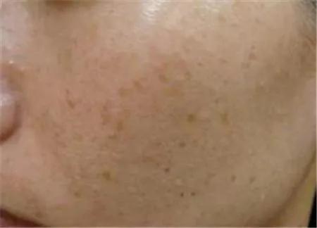 脸上各种斑图解,脸上常见6种斑点图片