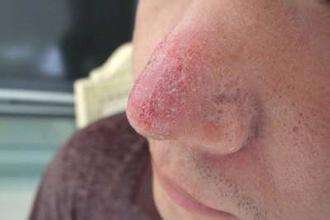 螨虫的最佳防治方法,螨虫感染的症状表现