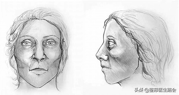 颧弓内推术颧骨磨骨,颧骨颧弓磨骨手术全过程