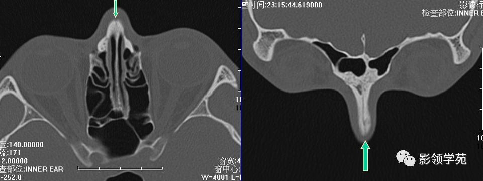 鼻骨骨折的检查方法,鼻骨骨折影像学表现