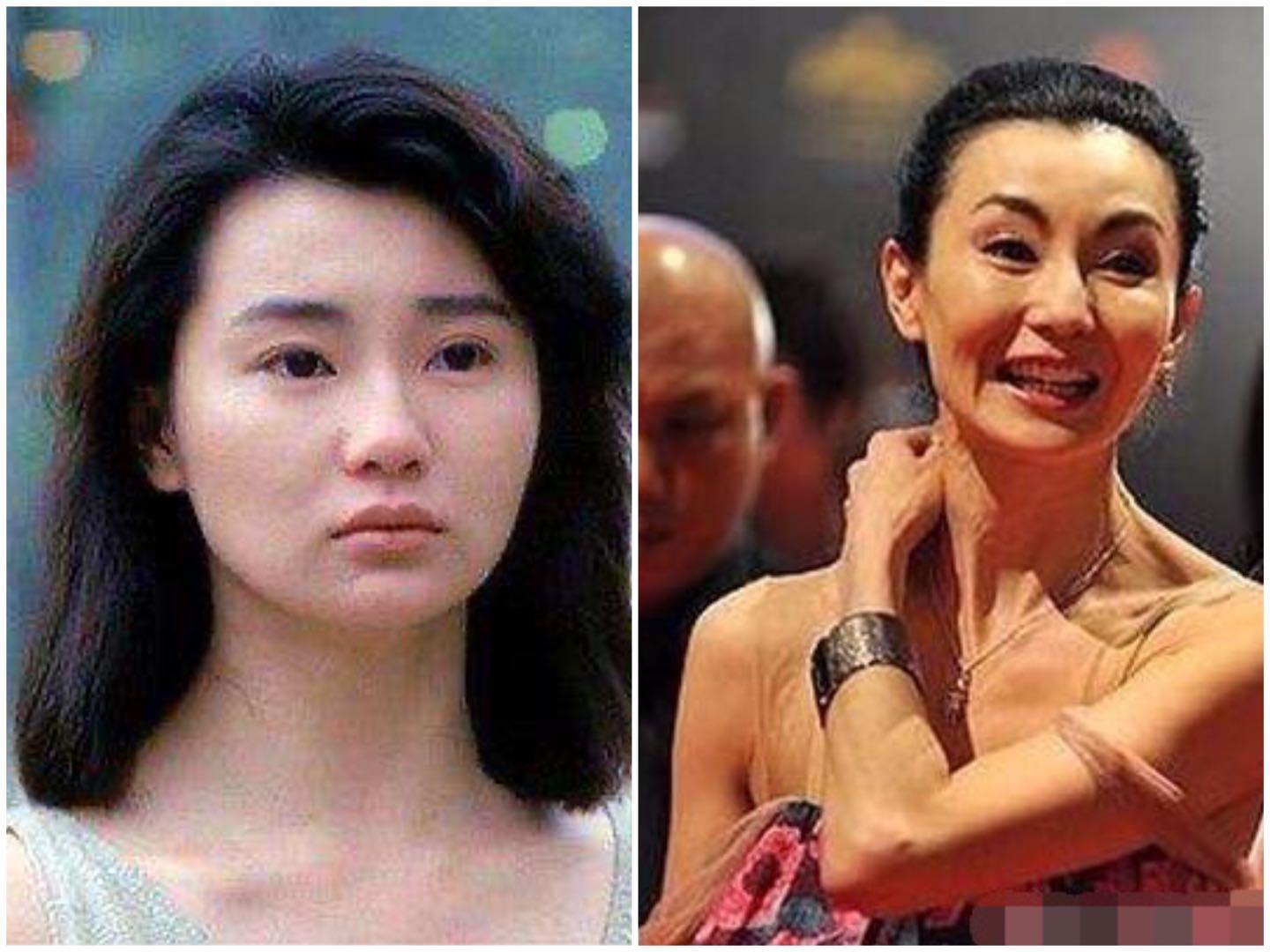 打水光针和打除皱针哪种好,打水光针和除皱针哪个好