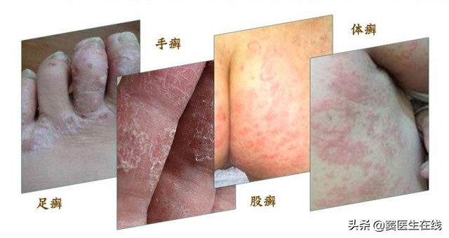 “脚气”真菌怎么治才能根除？2个简单小方法，彻底治好不复发
