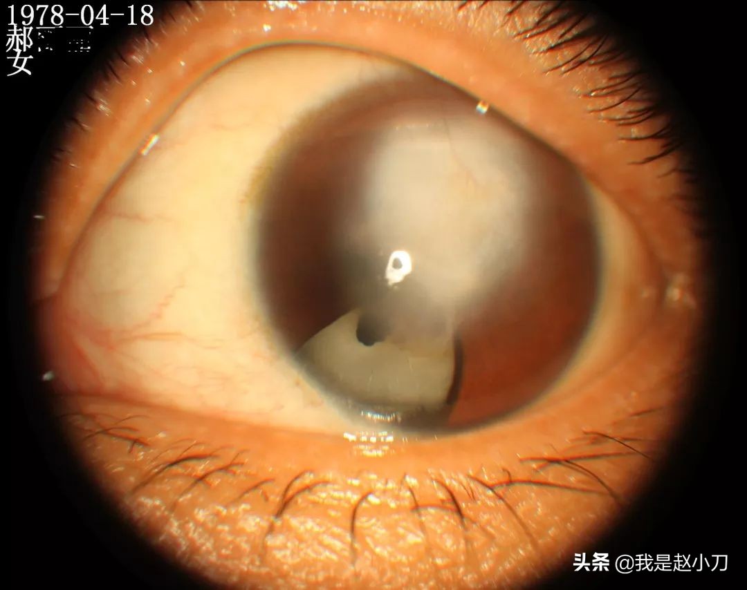 白内障专家赵小刀,白内障赵小刀