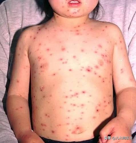 孩子发热出疹子怎么办,身上出疹子就是幼儿急疹吗