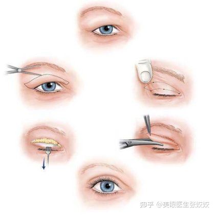 胖妹妹适合割双眼皮吗,胖女孩割双眼皮