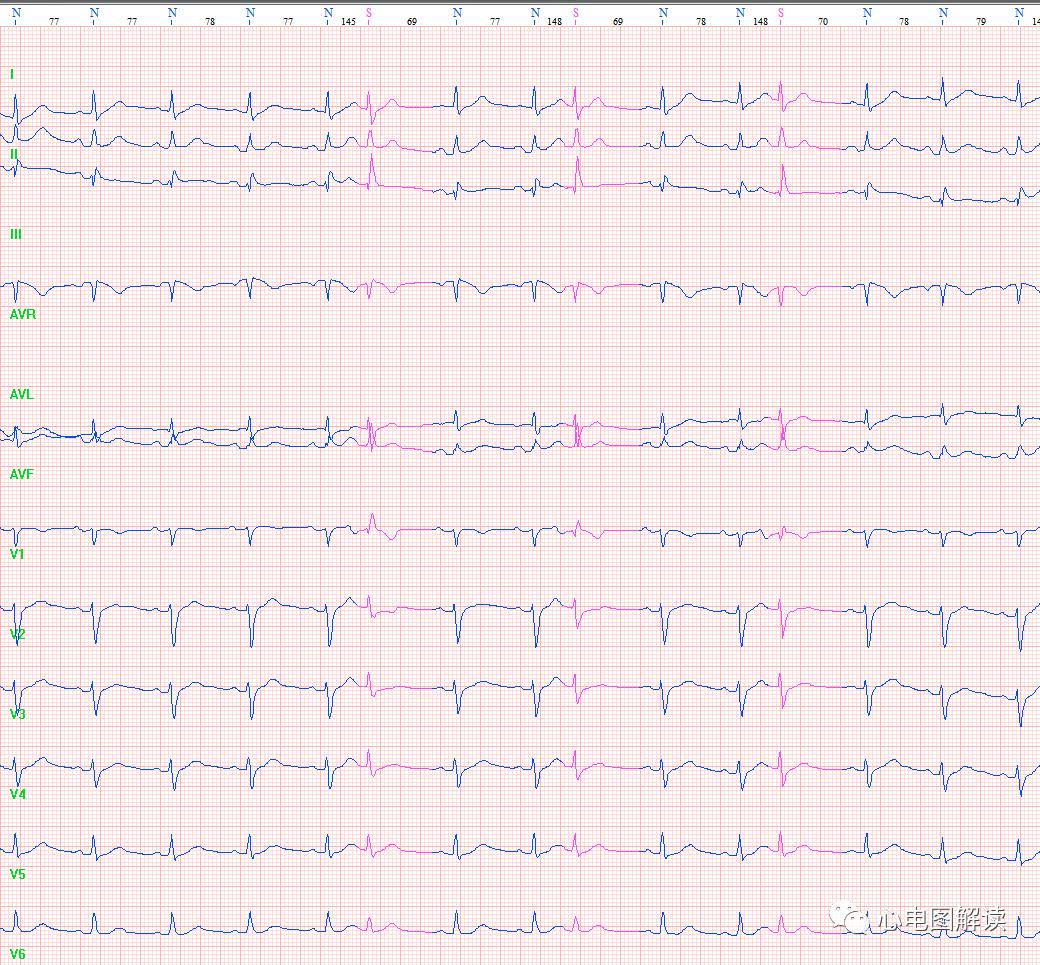 今天做心电图,每日分享心电图