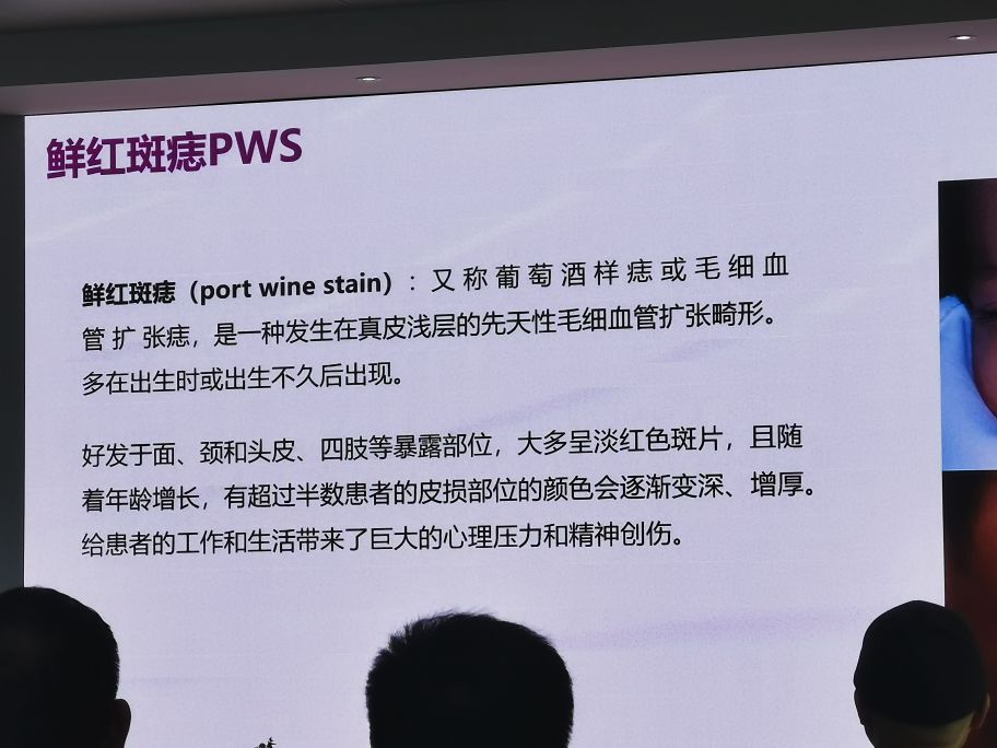 冷冻祛痣和脉冲染料激光,脉冲染料激光祛鲜红斑痣后有红印