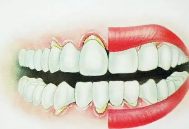 老人牙齿变长,老年人牙齿越大越容易出问题