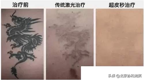 一擦祛斑靠谱吗,橡皮擦2秒祛斑能去掉斑吗