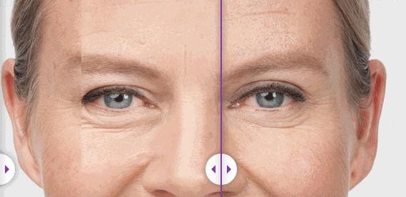 眼细纹和眼纹,眼部衰老导致眼纹