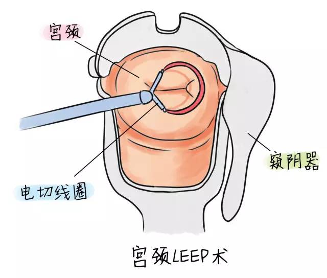 宫颈糜烂要不要治疗一文说清楚,宫颈糜烂10分钟红光治疗危害