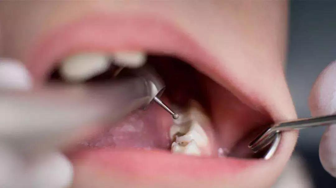 小米洗牙器四种模式,小米洗牙器9.9