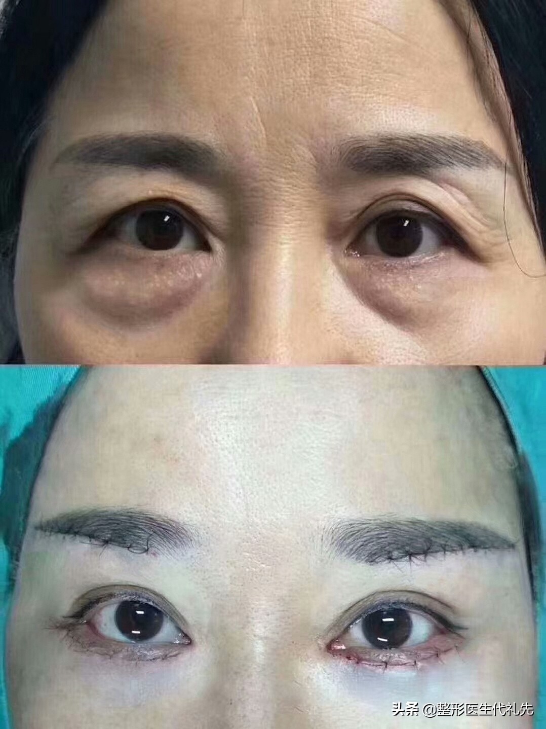 提眉手术的说法,提眉整形问答