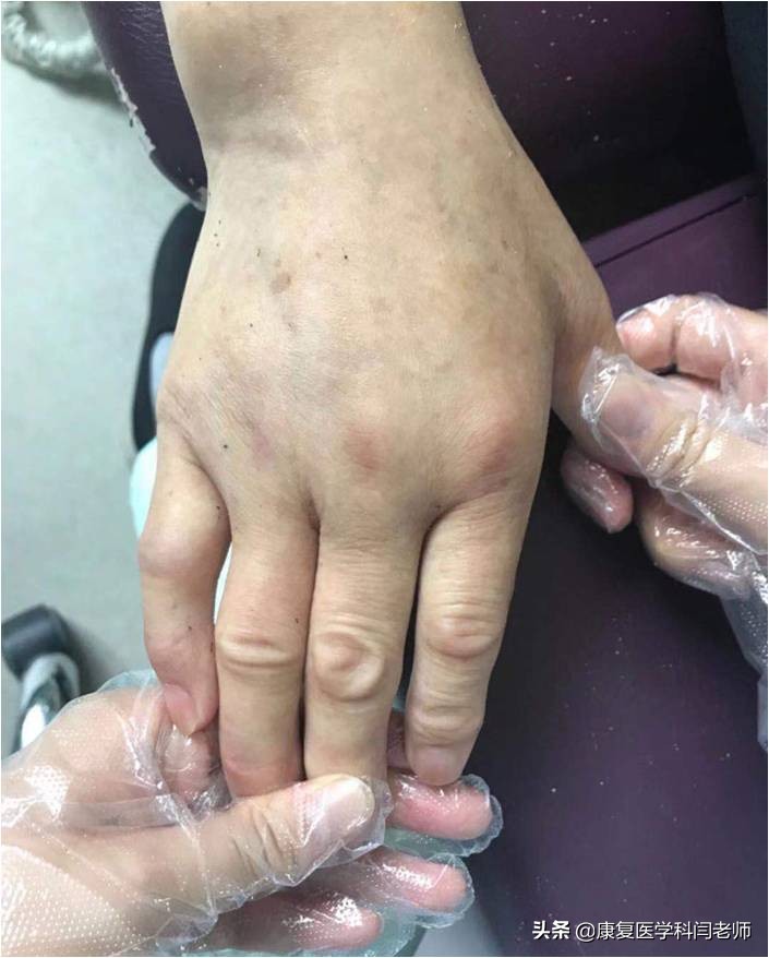 脑卒中后偏瘫患者常见并发症：肩手综合征的康复治疗