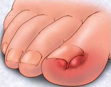 甲沟炎，灰指甲和脚气都有什么症状，该怎么治疗？