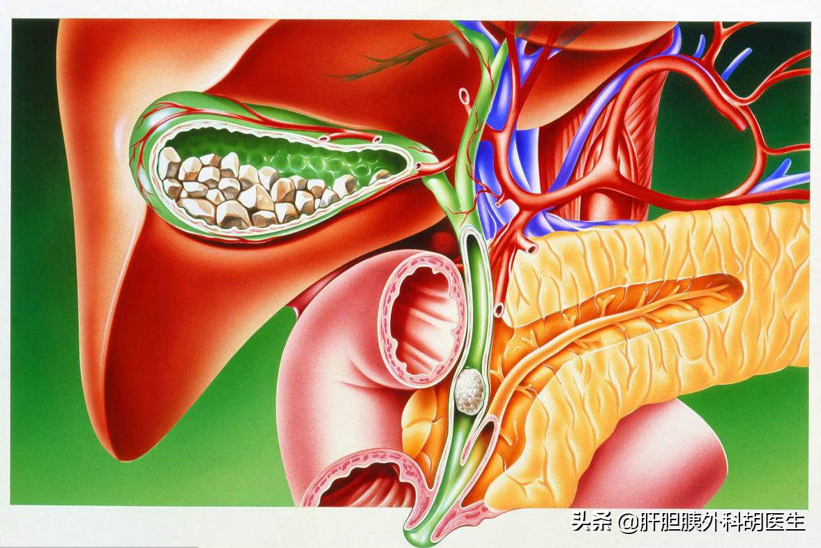 胆囊结石伴随胆囊息肉怎么办,胆囊息肉已经1.9厘米了会不会癌变