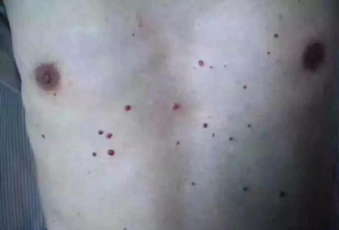 身上突然长咖啡色肉痣是咋回事,身上出现红色痣一定与肝脏有关吗