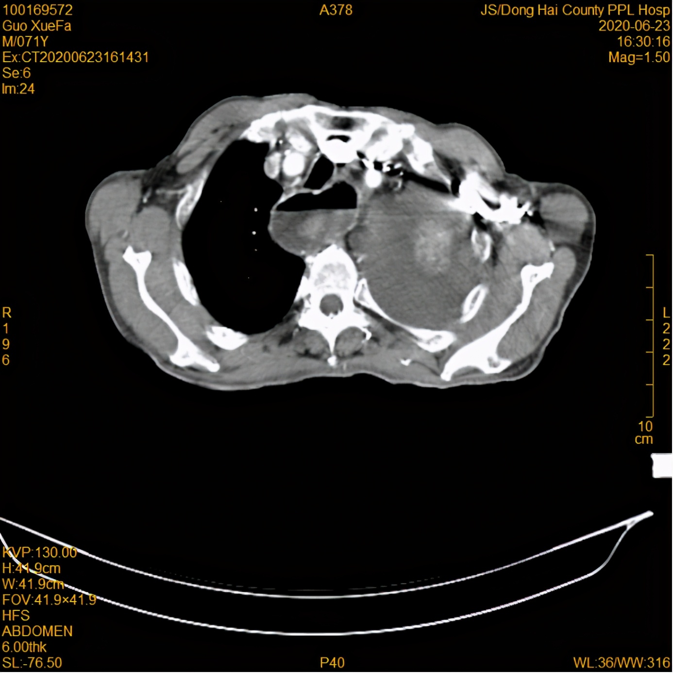 放疗后，82岁高龄食管癌患者情况好转
