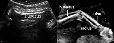 做彩超四维正常胎儿无畸形吗,胎儿脊柱超声几周做