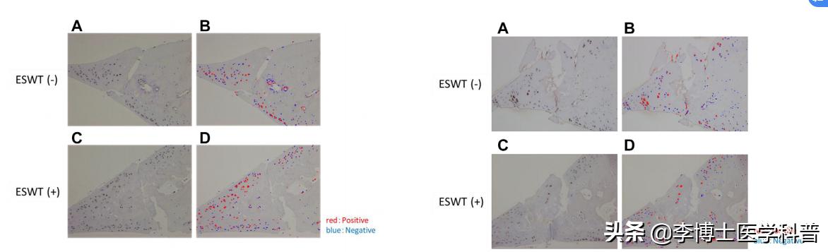 体外冲击波治疗半月板损伤国际最新研究成果报道