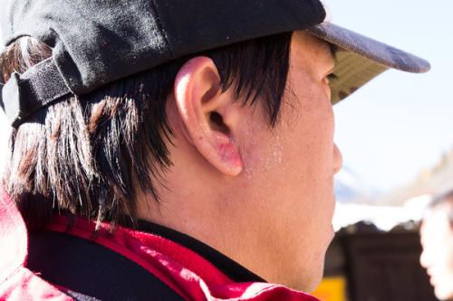 太阳晒伤皮肤怎么好,太阳晒伤最快办法