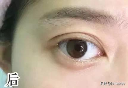 眼角皱纹最显老要注意防晒,眼角皱纹去皱最有效的方法