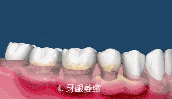 有肾病的人得了牙周炎怎么办,得了牙周炎用什么牙膏刷牙最好