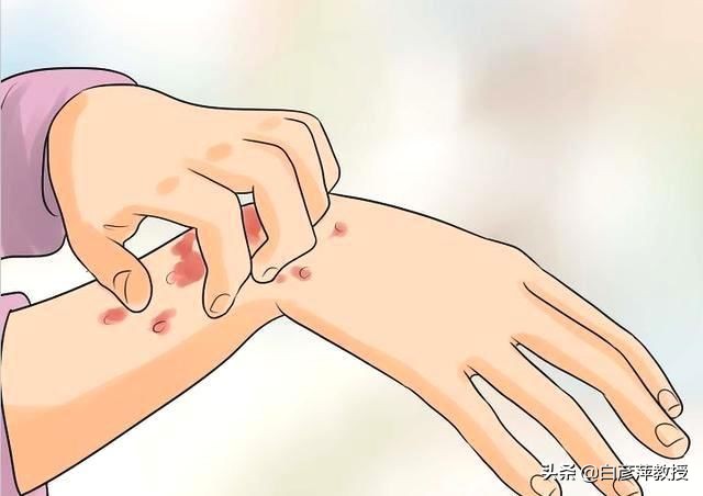 *麻疹荨**是啥病？哪些人容易患*麻疹荨**？这里给您解答