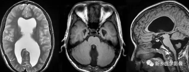 脑室为什么会扩张,脑室为什么会变小