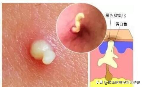 鼻子出油挤出白色的东西怎么解决,鼻子每天都能挤出白色油脂怎么治