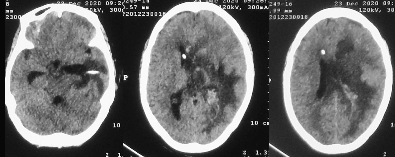 脑脓肿合并脑膜炎需要手术吗,脑脓肿进入左侧脑室严重吗