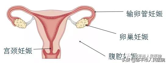 异位妊娠是不是输卵管出现问题,输卵管异位妊娠科普