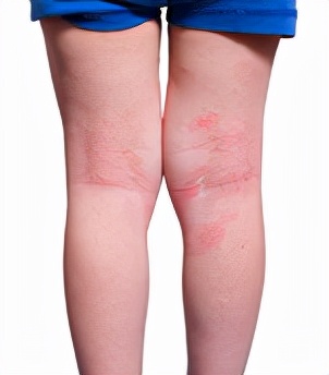 根除皮炎秘方,最难治的皮肤病脂溢性皮炎