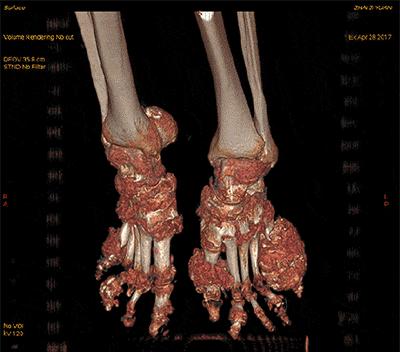 痛风怎么处理尿酸盐结晶,了解尿酸的最快方法