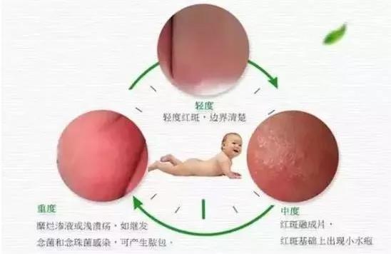 怪不得宝宝总是红屁屁，原来是这里出了问题！