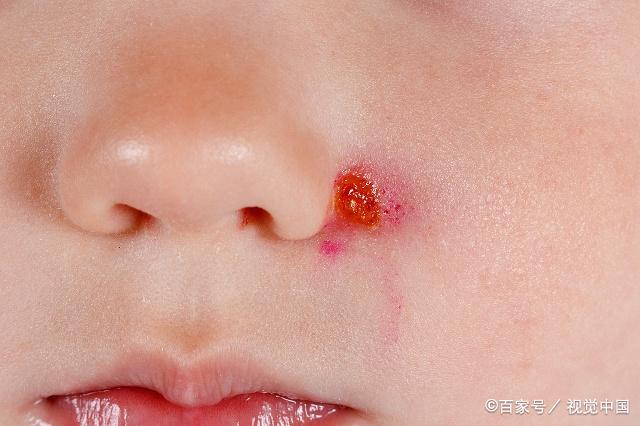 粉刺挑出来好还是不好,如果粉刺早挤了会怎样