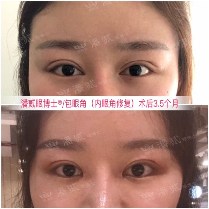 开眼角过大图片,开眼角过大修复效果图