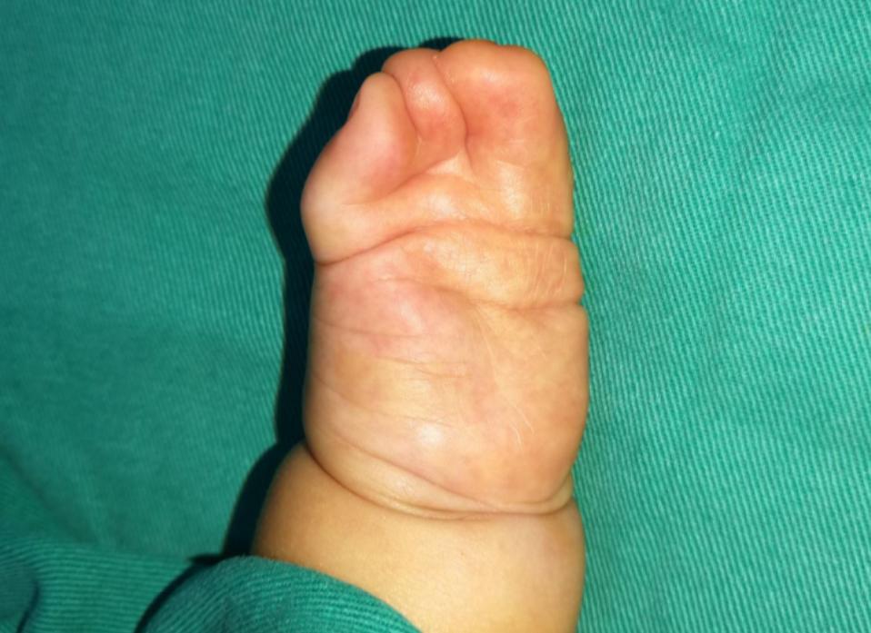 并指畸形免植皮案例,并指畸形