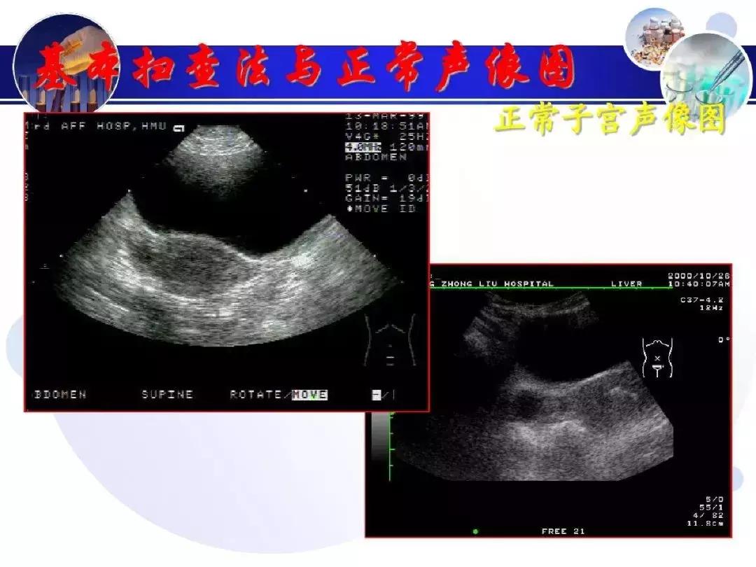纯干货！子宫及附件解剖和超声诊断