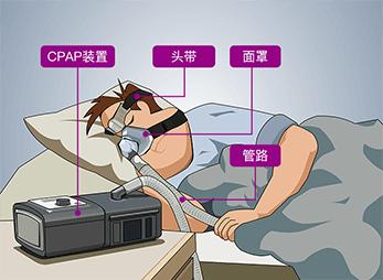 阻塞性睡眠呼吸暂停原理,什么叫阻塞性睡眠呼吸暂停综合征