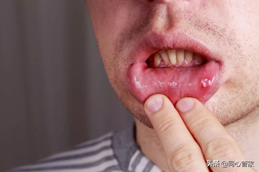 冠心病吃了药胃烧心怎么办,冠心病长期服药后胃溃疡处理