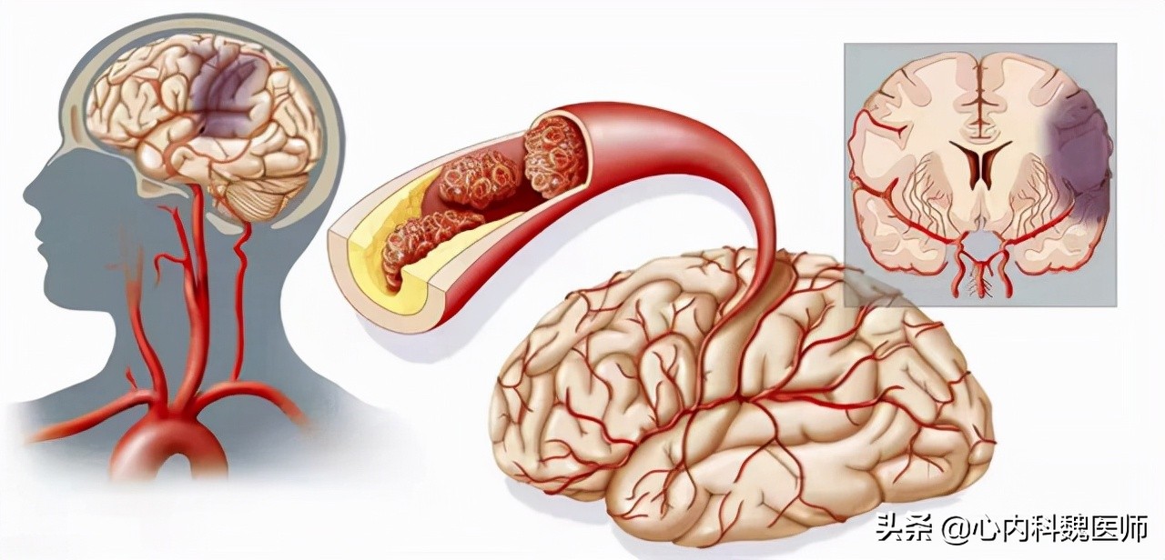 在美国，叶酸大面积下架，我国卒中患者还要补吗？叶酸咋吃才对？